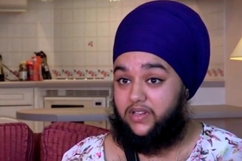 Chuyện lạ cô gái mọc râu quai nón